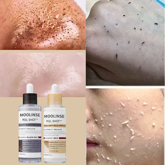 Blackhead Removal
