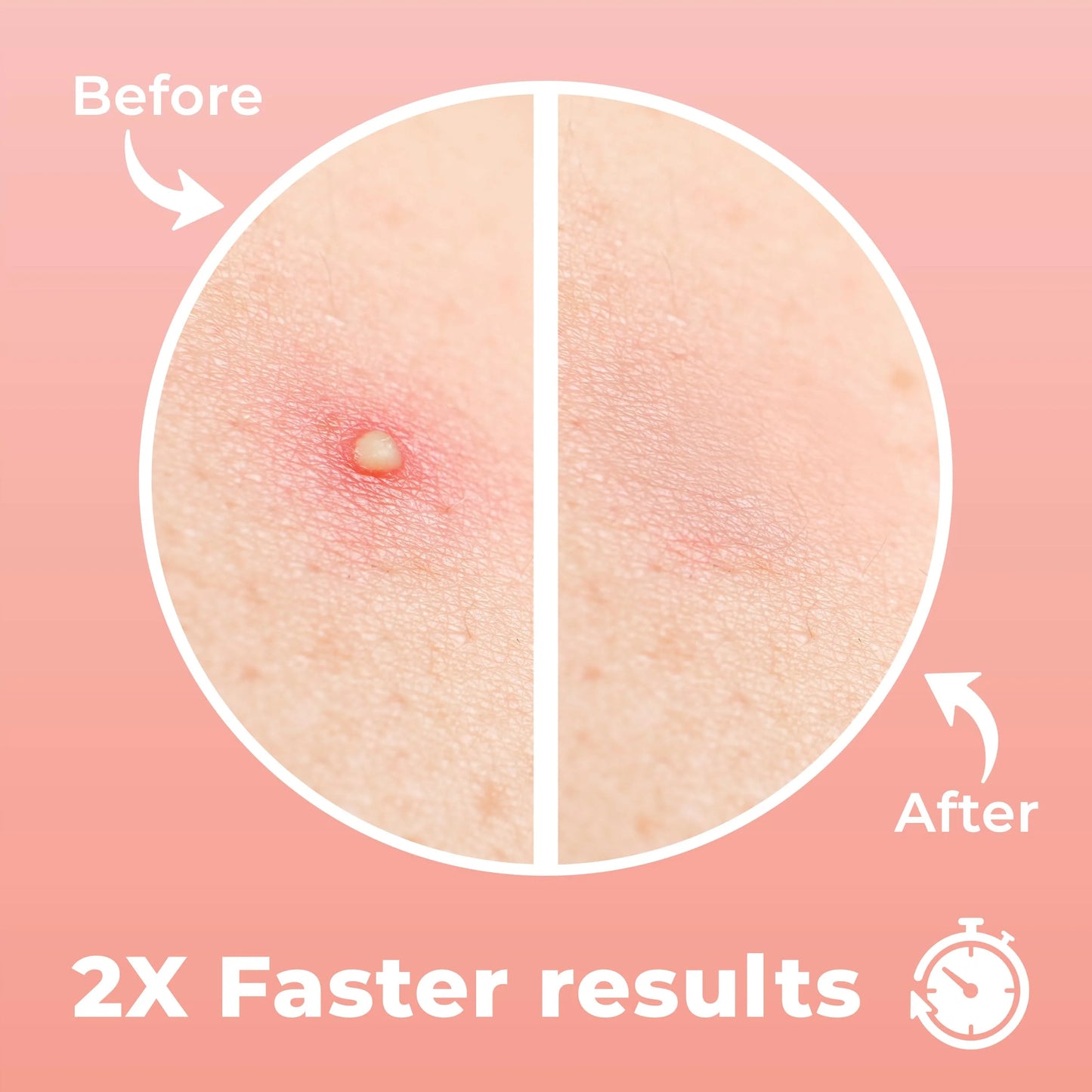 Korean Skincare Acne Patches 24pcs