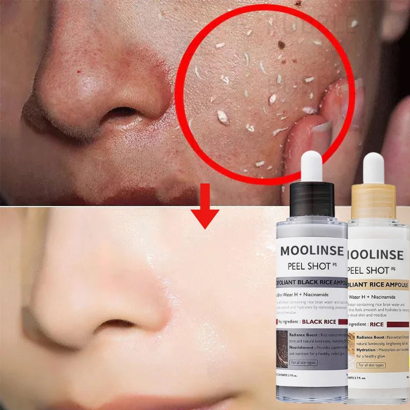 Blackhead Removal