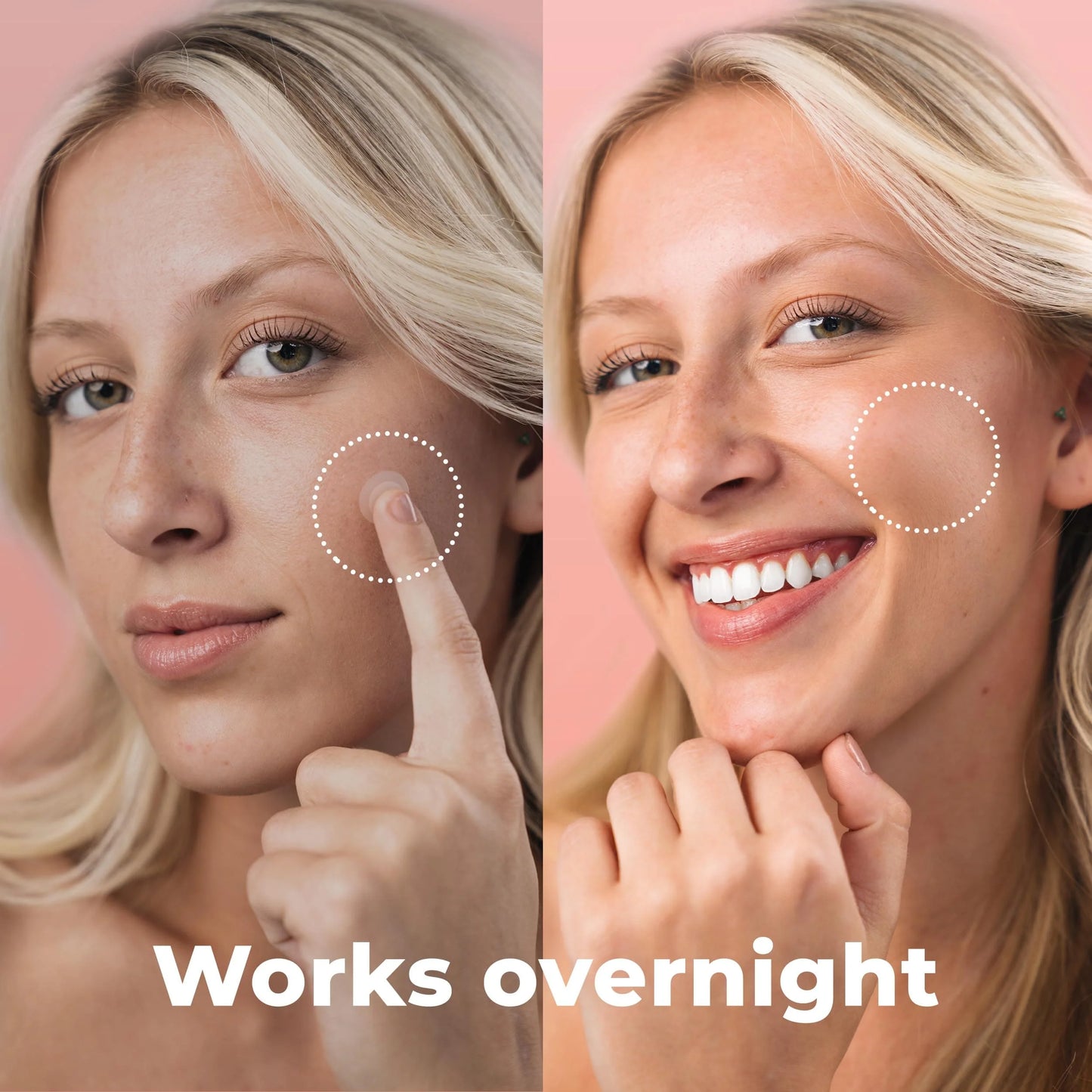 Korean Skincare Acne Patches 24pcs