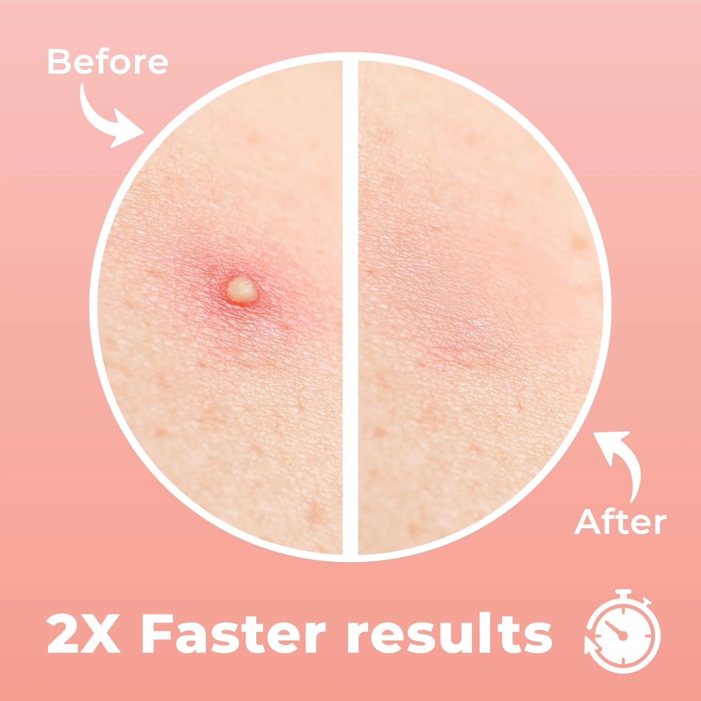 Korean Skincare Acne Patches 24pcs